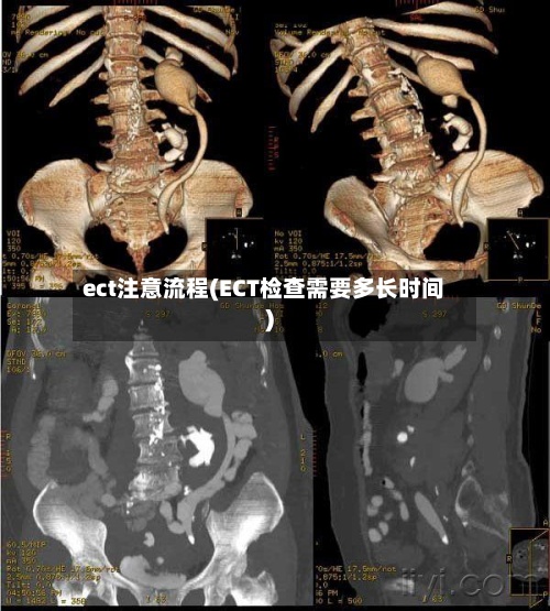 ect注意流程(ECT检查需要多长时间)-第2张图片